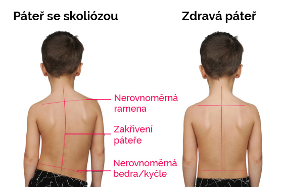 Vadné držení těla u dětí